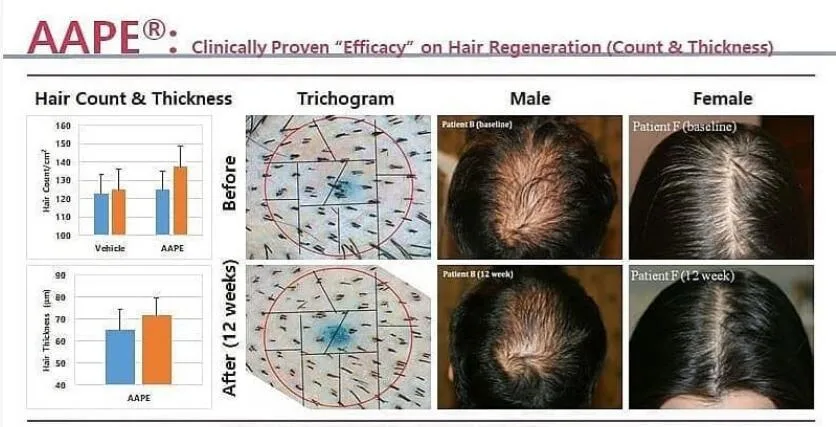 Korean Aape Hair Growth Extracted From Human Adipose Stem Cells Pattern Baldness Hair-Loss Prevention Men Women Microneedling Hair Growth Serum Treatment